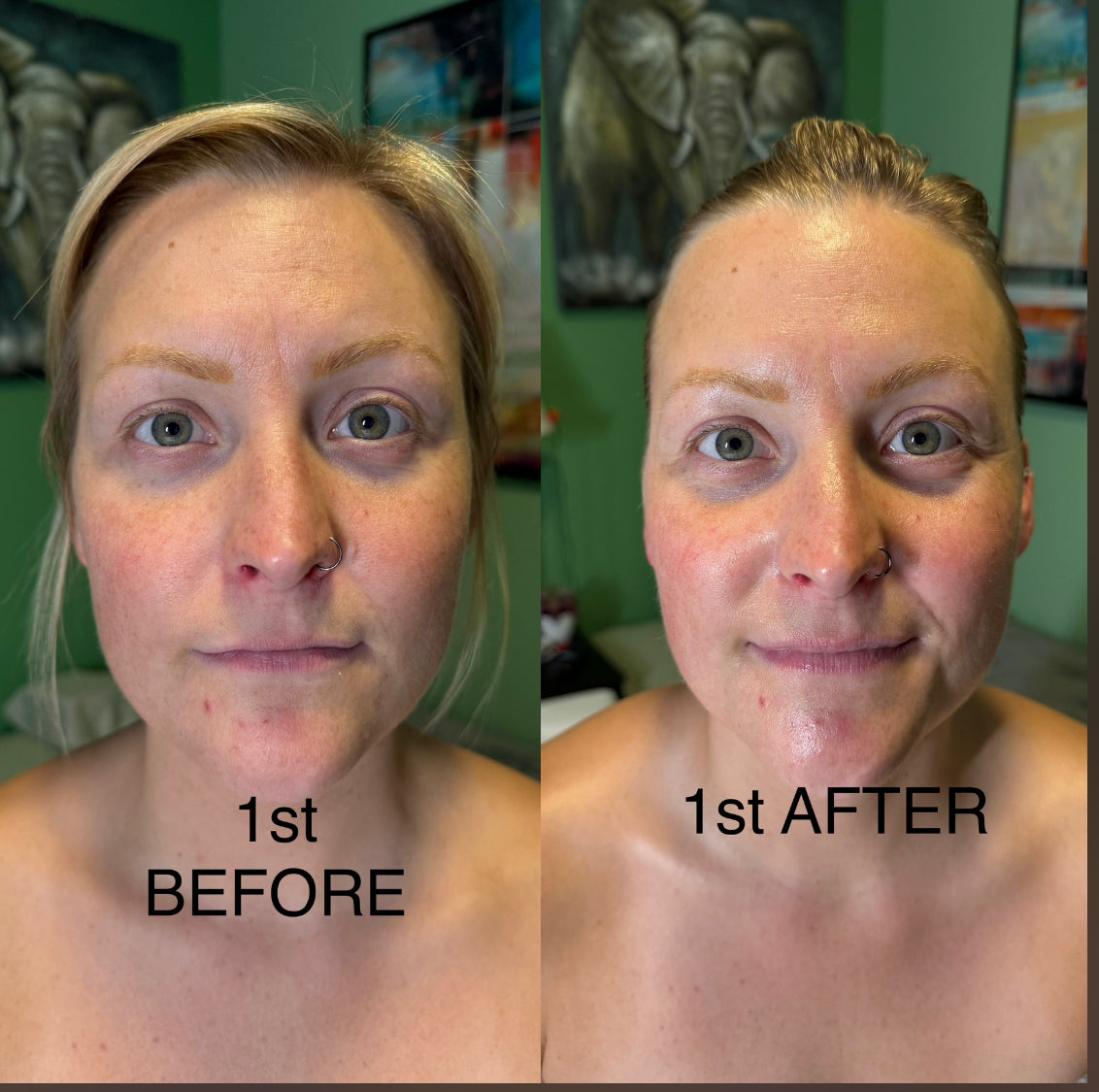 Extensive Buccal Facelift With Lymphatic Drainage & Myofacial Release Treatment (Includes LED Light Therapy) 100 Minutes